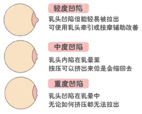 乳暈 長毛|乳頭內凹、長毛正常嗎？ 8類「乳頭形狀」你的是哪種 